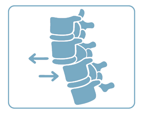 Spondylolisthesis Management